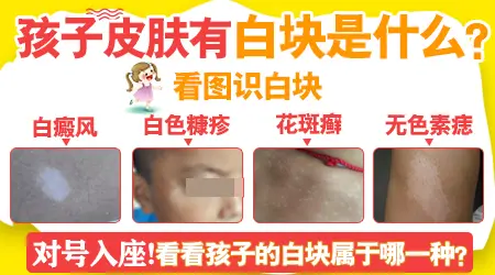 小孩脸上长白块 白斑图