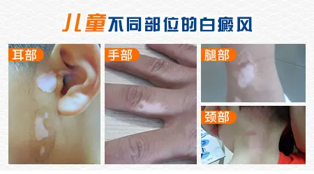 儿童白癜风的早期症状表现