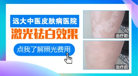 儿童白癜风照308激光怎么样