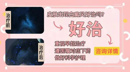 小孩白癜风早期治好的概率大不大