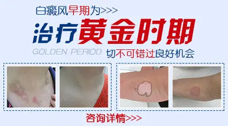 小孩白癜风早期治好的希望大吗