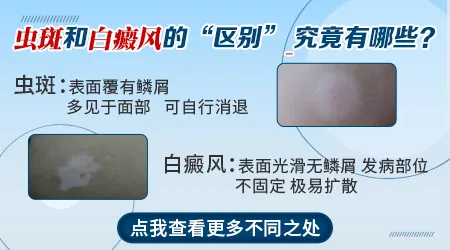 孩子脸上长白块是虫斑吗