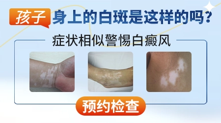 儿童大腿外侧出现白斑是什么情况