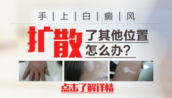 男性手部白癜风扩散了是什么原因