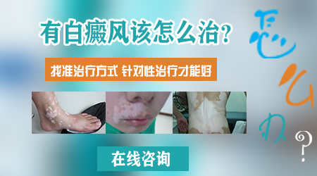 三十岁男性腰部白癜风两三年了怎么治