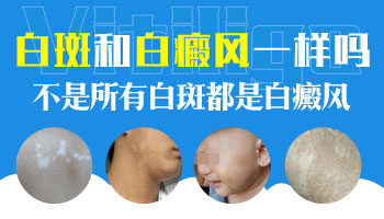 孕妇肚子上出现白斑是白癜风吗