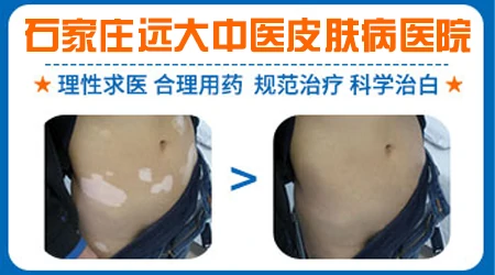 女孩额头长白斑怎么回事