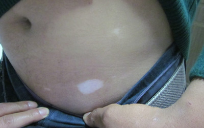 17岁男孩肚子上有两块淡白色的白斑还扩散了