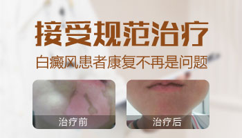 伍德灯照手指白斑显示浅蓝白色什么意思