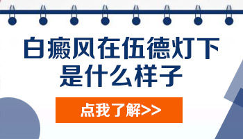 伍德灯检查结果是白斑显示瓷白色荧光