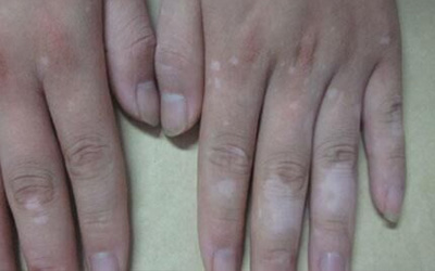 手指关节皮肤变白怎么回事