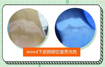 wood灯下出现蓝白色斑片