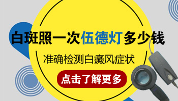 伍德灯检查白斑一次多少钱