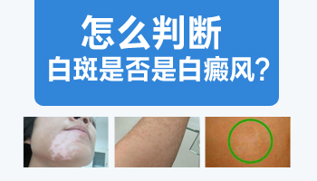 腰部和大腿内侧有白斑是不是白癜风怎么判断