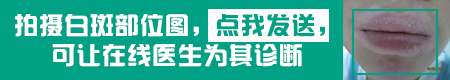 怎么判断自己得了白癜风