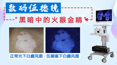 伍德镜检查白斑能确诊吗