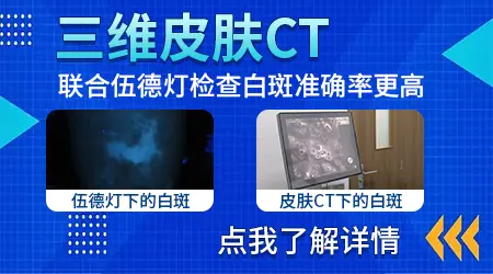 皮肤ct白癜风的结果单