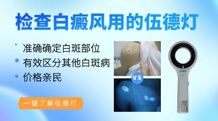 伍德灯检查白斑准吗