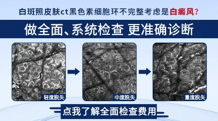 伍德灯下的各种白斑图分别什么样
