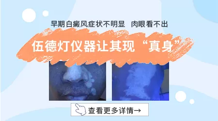 白癜风早期在伍德灯下表现图片