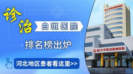 伍德灯下的白癜风是什么样的图片