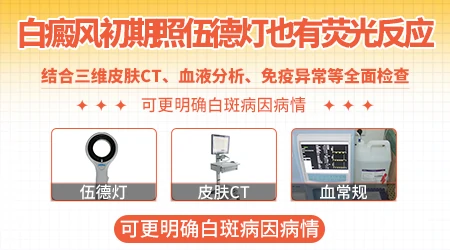 荧光不明显还有可能是早期白癜风吗