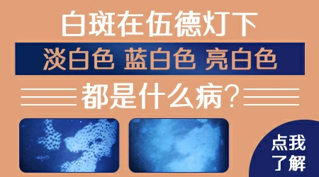 伍德灯下皮肤显示淡白色什么意思