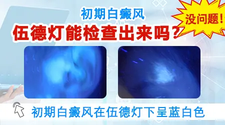 白癜风早期在伍德灯下显示什么样