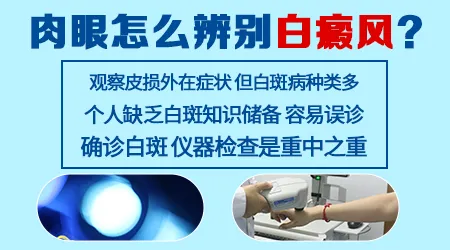 只看肉眼能确诊白癜风吗