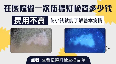 伍德灯检查白斑多少钱一次