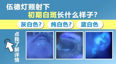 伍德灯下白斑呈灰白色是不是白癜风