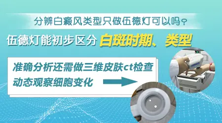 伍德灯能判断白斑是进展期还是稳定期吗