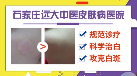 伍德灯结果显示白斑有荧光就是白癜风吗