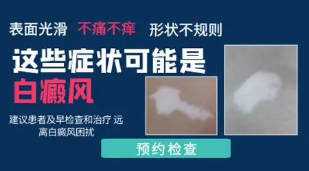 白斑摸着光滑不起皮不痒就是白癜风吗