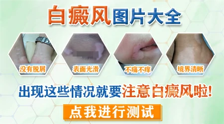 身上的白斑边界很清楚是不是白癜风