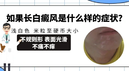 怎么分辨自己的白斑是不是白癜风