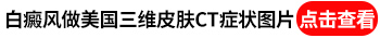 大腿内侧长了一个白斑