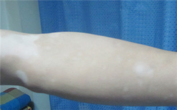 白癜风手臂初期症状图片