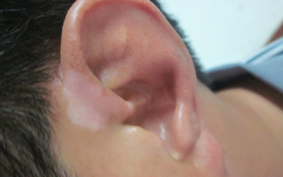 耳朵旁边的皮肤发白一块是什么