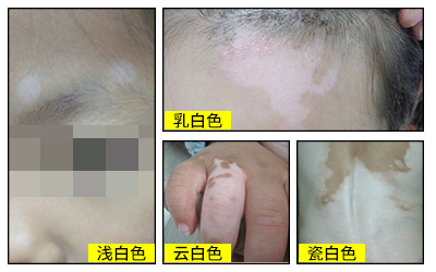 白癜风瓷白色和白色的区别