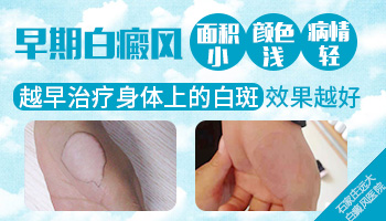 初期白癜风的症状表现都有什么