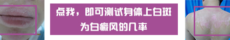 什么样的白斑是正常的 白癜风长什么样