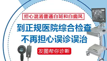 手部白癜风的早期症状有哪些