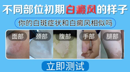 白癜风刚刚发作是什么样的