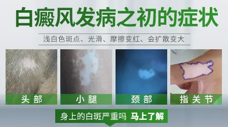 白癜风的症状是什么样子