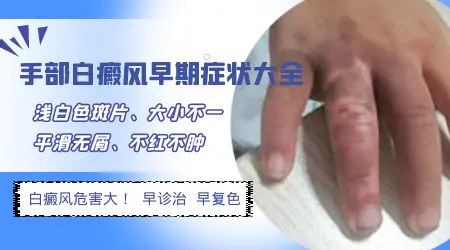 手指白斑初期症状图片