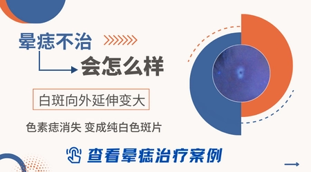 晕痣白斑早期症状图片