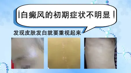 身上皮肤出现初期白癜风症状图片