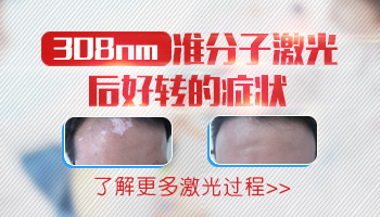 激光308治白癜风多少钱一次