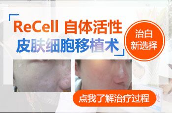recell黑色素细胞再生术治疗白癜风过程